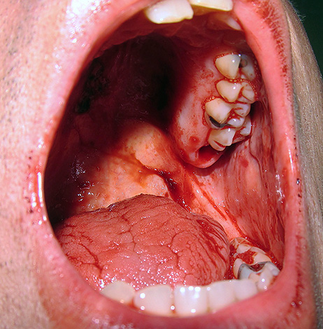 Se o sangramento do orifício do dente extraído não parar por muito tempo, medidas adicionais devem ser tomadas para detê-lo.