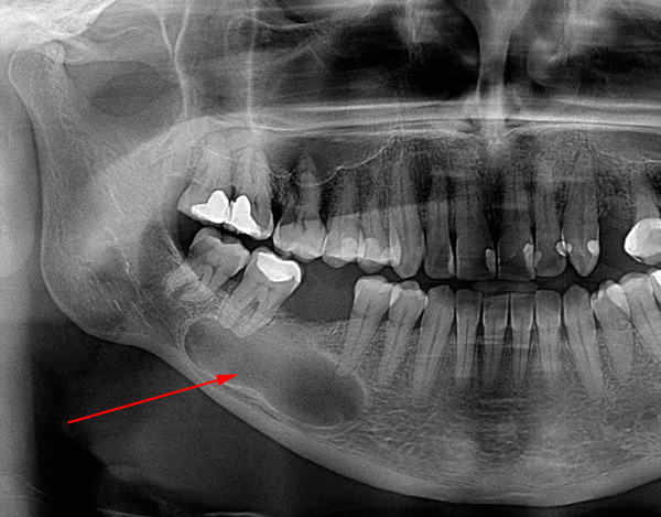 Em alguns casos, o cisto cresce para um tamanho muito impressionante e começa a ameaçar a saúde dos dentes vizinhos.