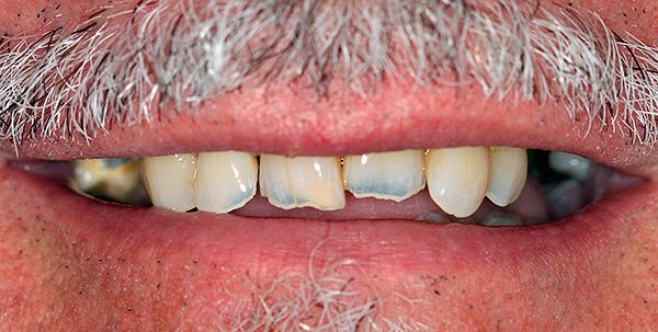 Hoje acredita-se que focos infecciosos nas raízes do dente apresentem riscos adicionais para o desenvolvimento de doenças do sistema cardiovascular.
