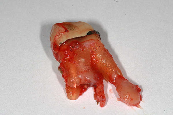 Na maioria dos casos, os dentes com cistos nas raízes devem ser removidos, mas o tratamento conservador das neoplasias é frequentemente possível.
