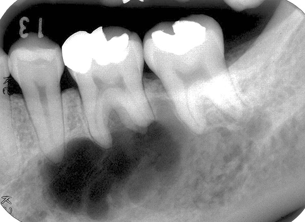 Um exemplo de uma situação em que um cisto captura as raízes de dois dentes ao mesmo tempo.