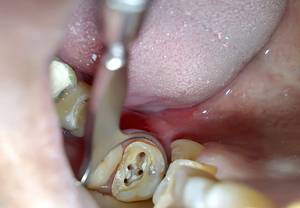 Às vezes, o cisto na raiz desaparece após um tratamento de qualidade dos canais dentários.