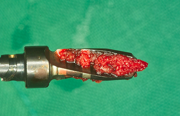 Con l'impianto classico di denti nell'osso, viene praticato un foro utilizzando una taglierina speciale, che è una procedura piuttosto traumatica.