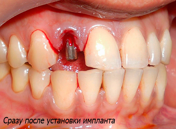 L'impianto immediato prevede l'installazione di un impianto nel foro immediatamente dopo l'estrazione del dente.