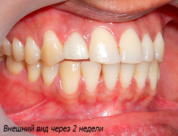 Ecco come appare il risultato dell'impianto dopo 2 settimane: un dente artificiale non può essere distinto dai parenti.