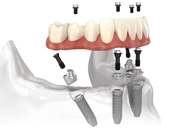Uno dei tipi più popolari di impianti dentali oggi è la tecnologia All-on-4.