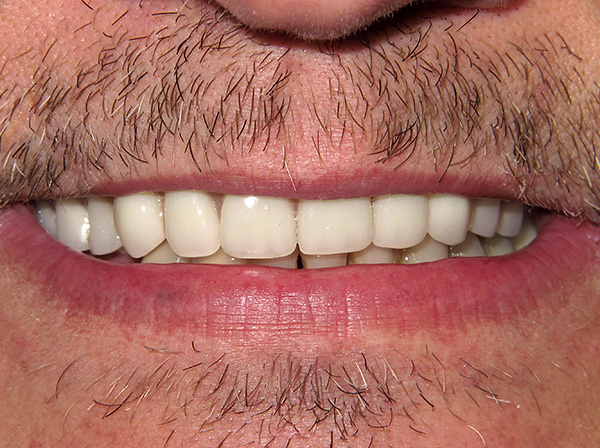 Estetica e funzionalità della dentizione restaurate.