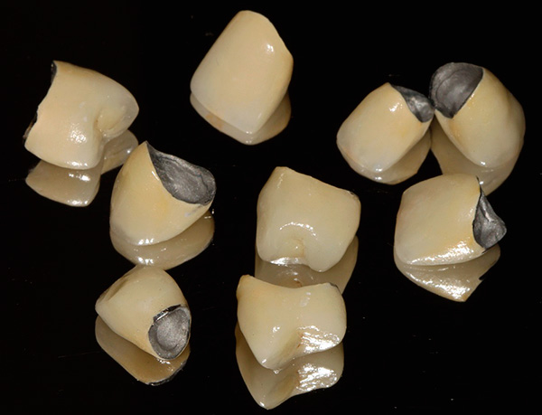 Le corone in metallo-ceramica sono piuttosto estetiche e affidabili a un costo relativamente basso.