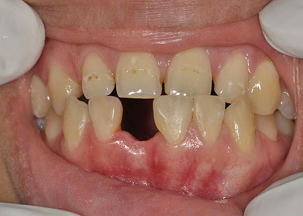 Uno dei denti anteriori è stato rimosso sulla mascella inferiore, il foro è già guarito.