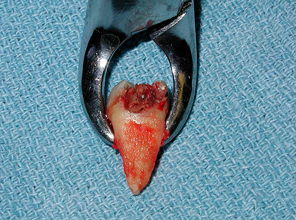 Vamos falar sobre a extração dentária e como reduzir a probabilidade de problemas, mesmo após um procedimento complexo ...