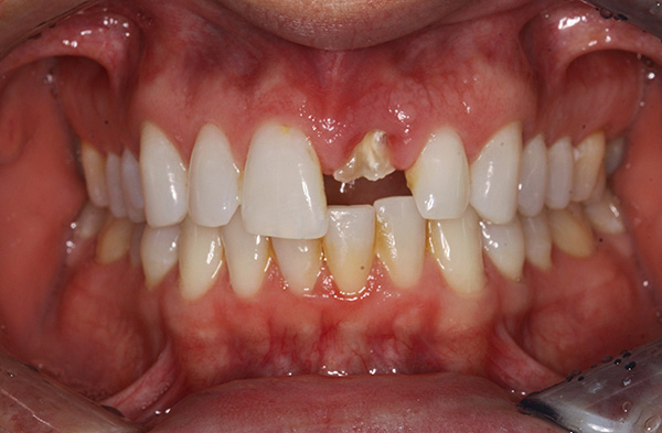 Após a remoção da raiz, o dente da frente pode ser restaurado no implante.