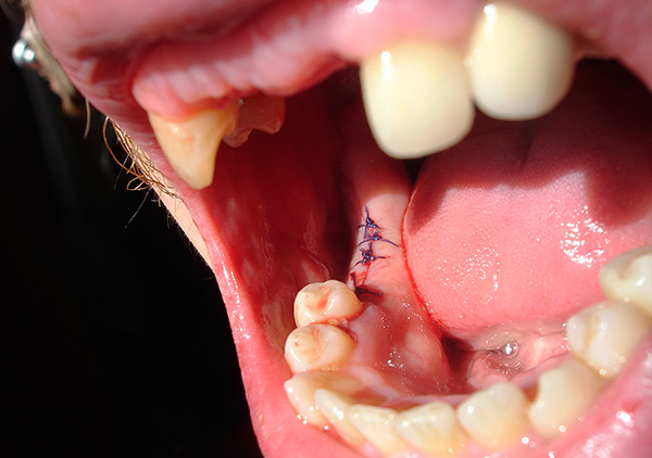 Com uma ferida significativa formada após a extração do dente, o cirurgião-dentista pode costurar.