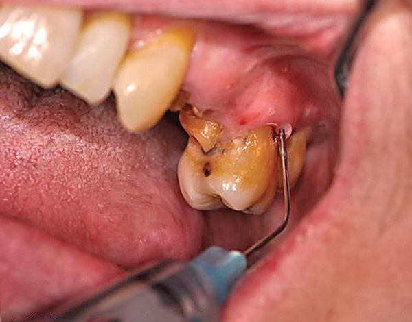A qualidade da anestesia depende completamente da intensidade da dor durante a extração dentária.