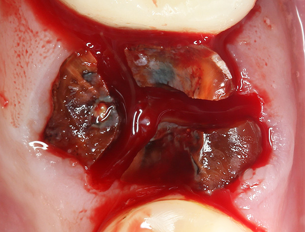 O dente é serrado em três partes (pelo número de raízes), para que seja mais fácil remover com mínimo trauma o tecido circundante.