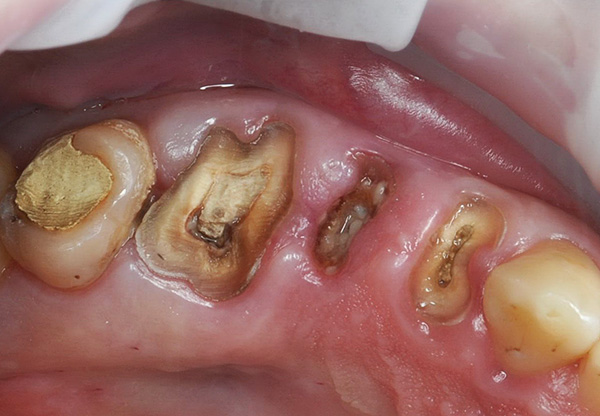 Os três dentes a serem extraídos são pré-cortados no nível gengival.