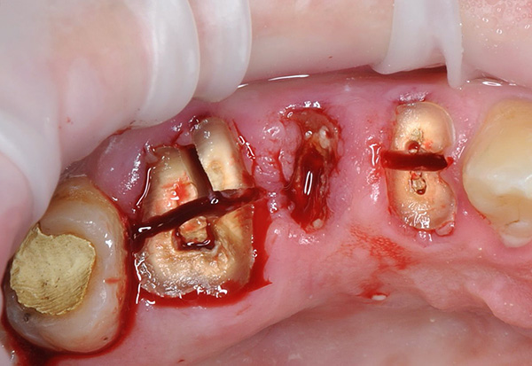 Antes da remoção dos dentes, os dentes são serrados por uma broca em peças ...