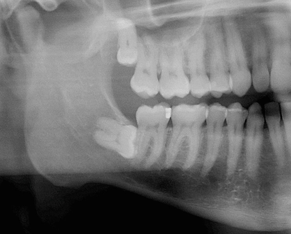 A retina do dente do siso, situada horizontalmente no osso da mandíbula inferior, é claramente visível na figura.