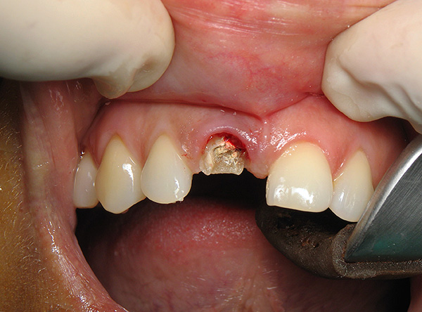 A atitude inadequada dos pacientes em relação ao problema da extração dentária e a baixa conscientização dessa operação geralmente levam a sérias conseqüências.