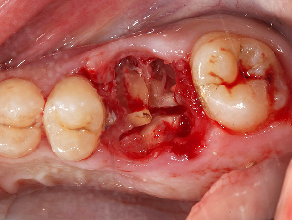 Às vezes as raízes do dente são separadas uma da outra com um cinzel e um martelo, e às vezes cortadas com uma broca.