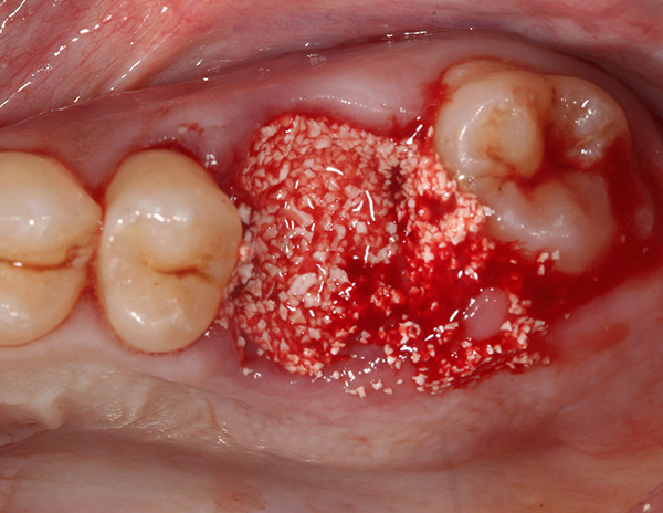 A foto mostra um exemplo de preenchimento de um orifício dentário com material ósseo artificial.