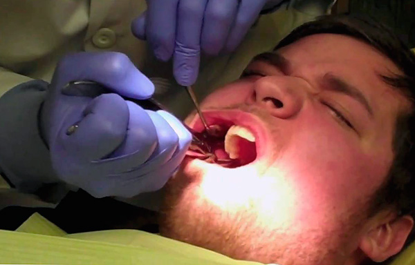Para que o procedimento de extração dentária ocorra sem problemas, é útil conhecer algumas nuances ...