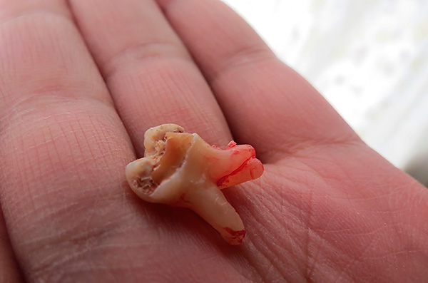 Se desejar, hoje você pode remover os dentes com um preço bastante baixo - a faixa de preço desse serviço em diferentes clínicas é muito grande.