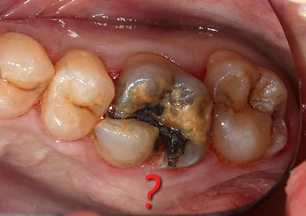 Em alguns casos, pode ser difícil dizer inequivocamente se um dente está sujeito a remoção ou se ainda pode ser salvo.