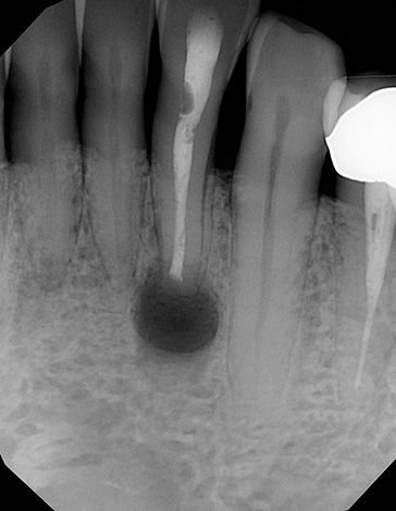 A imagem mostra um dente com um cisto na área da raiz.