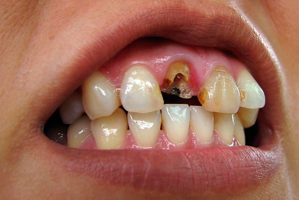 Muitas vezes, o dente quebra, de modo que a raiz não pode mais ser usada como suporte para a inserção e a coroa - nesse caso, a raiz está sujeita a extração.