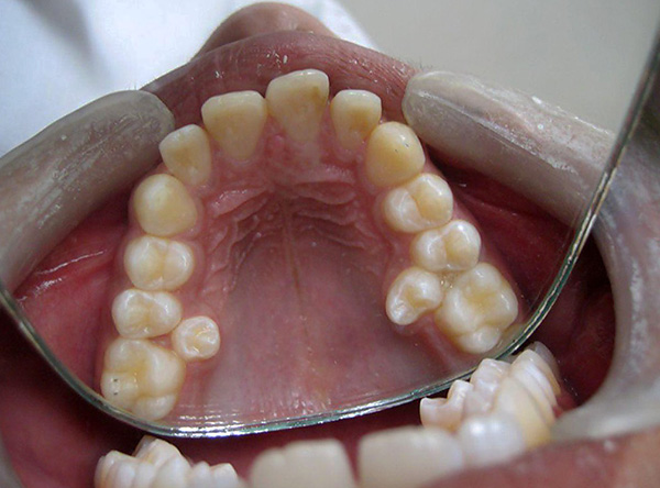 Dentes supranumerários são geralmente removidos.