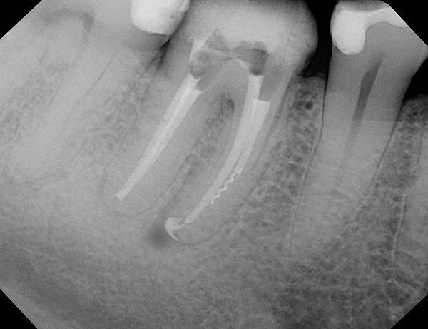 O fragmento de um instrumento dentário no canal radicular do dente é claramente visível na imagem - geralmente isso leva a inflamação na raiz.