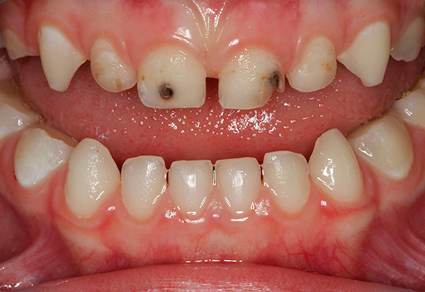 Mesmo os dentes de leite, se necessário, devem ser tratados para evitar perdas prematuras.