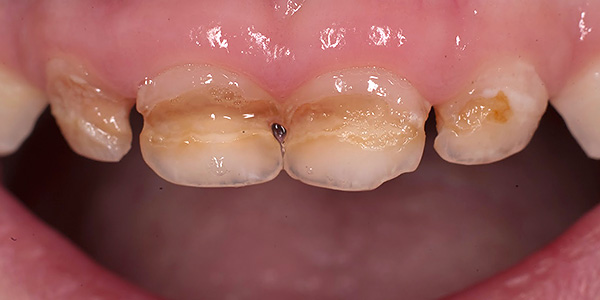 Outra foto com um exemplo de cárie de dentes decíduos em uma criança.