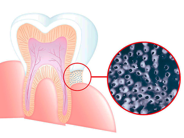 L'immagine mostra schematicamente l'esposizione della dentina nell'area cervicale del dente: la dentina è penetrata dai tubuli più sottili che portano alla polpa.