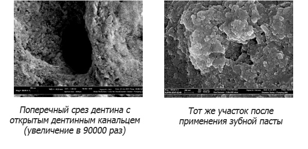 Riempimento del tubulo dentinale con nanoidrossiapatite dal dentifricio.
