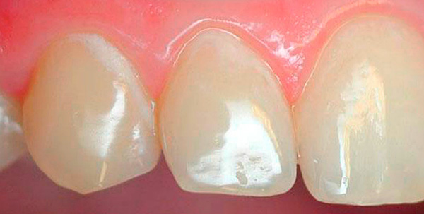 Le aree bianche sui denti sono aree di intensa demineralizzazione dello smalto (carie nella fase di una macchia bianca).
