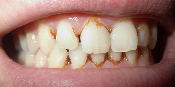 Con una placca dentale pronunciata, le proprietà chiarificanti della chiarificazione Smalto delicato potrebbero non essere sufficienti.