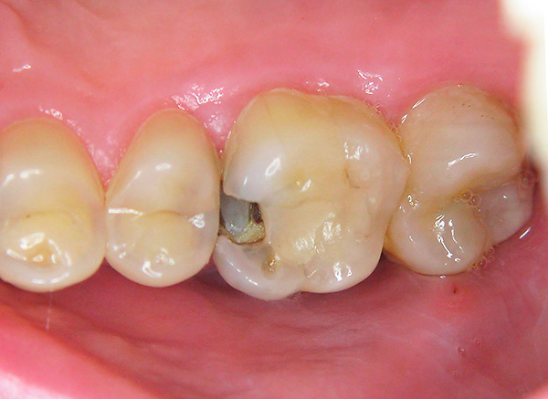 Nessun dentifricio ripristina i denti se in essi si sono già formate profonde carie.