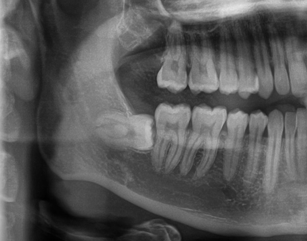 Un dente del giudizio semi-rinforzato che giace orizzontalmente nell'osso mascellare.