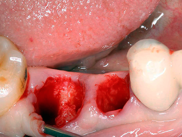 Più denti vengono rimossi, più forte sarà la risposta.