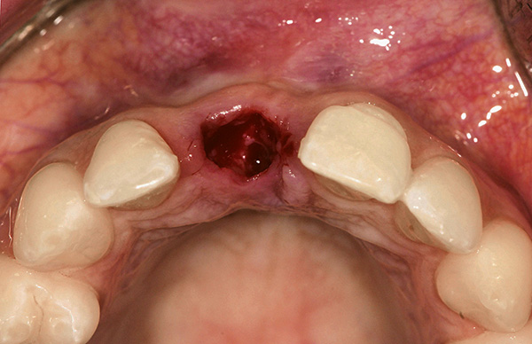 È importante seguire tutte le raccomandazioni del medico per la cura delle ferite dopo l'estrazione del dente, altrimenti aumenta il rischio di sviluppare gravi complicanze.