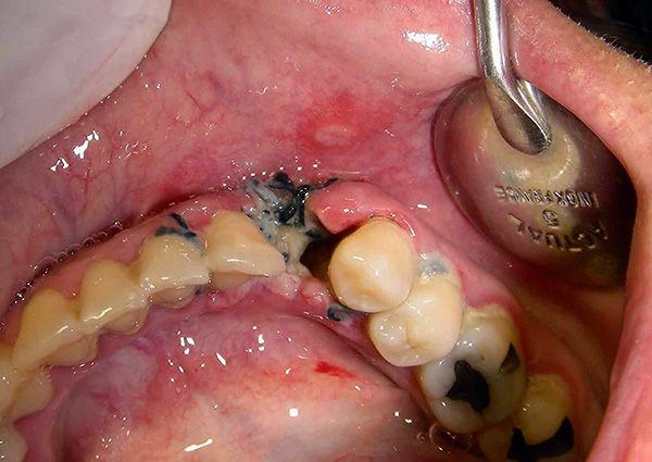 Alveolite (infiammazione del foro dopo l'estrazione del dente).
