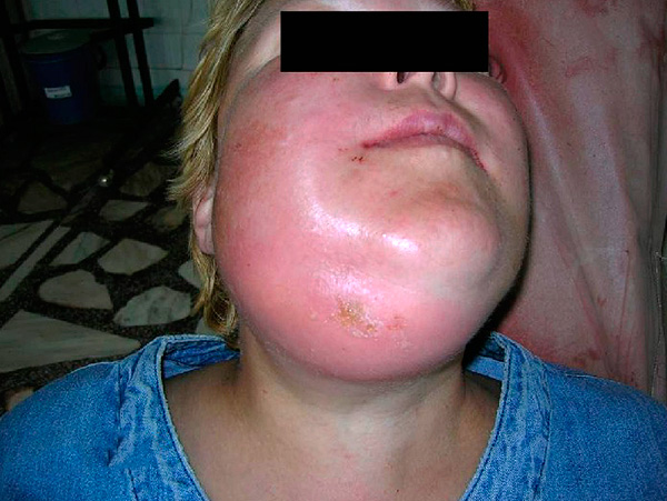 Ecco come appare il flemmone (infiammazione purulenta diffusa).