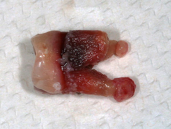 Dente con cisti sulle radici