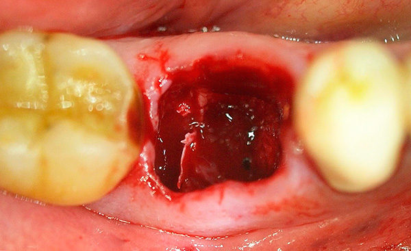 Se i tessuti infetti erano presenti sulle radici del dente, in futuro ciò potrebbe contribuire all'infiammazione del pozzo (incluso lo sviluppo dell'alveolite).