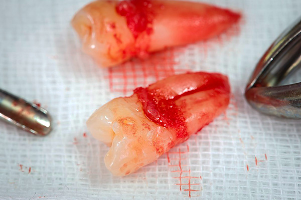 Spesso un chirurgo dentale deve rimuovere denti completamente sani, ad esempio i denti del giudizio.