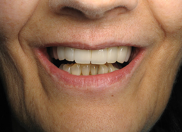 As próteses de fecho permitem não apenas devolver a capacidade de mastigar alimentos normalmente, mas também obter um sorriso bonito.