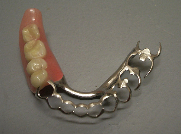Em alguns casos, pelas próteses de fecho, é possível salvar os dentes móveis do paciente da remoção devido ao efeito de tala da estrutura.