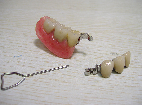 Dentaduras em implantes são caracterizadas por estética aumentada, facilidade de uso e fixação confiável na cavidade oral.