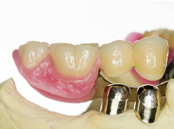 As coroas da parte removível da prótese são colocadas nas coroas montadas nos dentes do pilar.